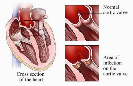 أمراض القلب ومخاطرها
